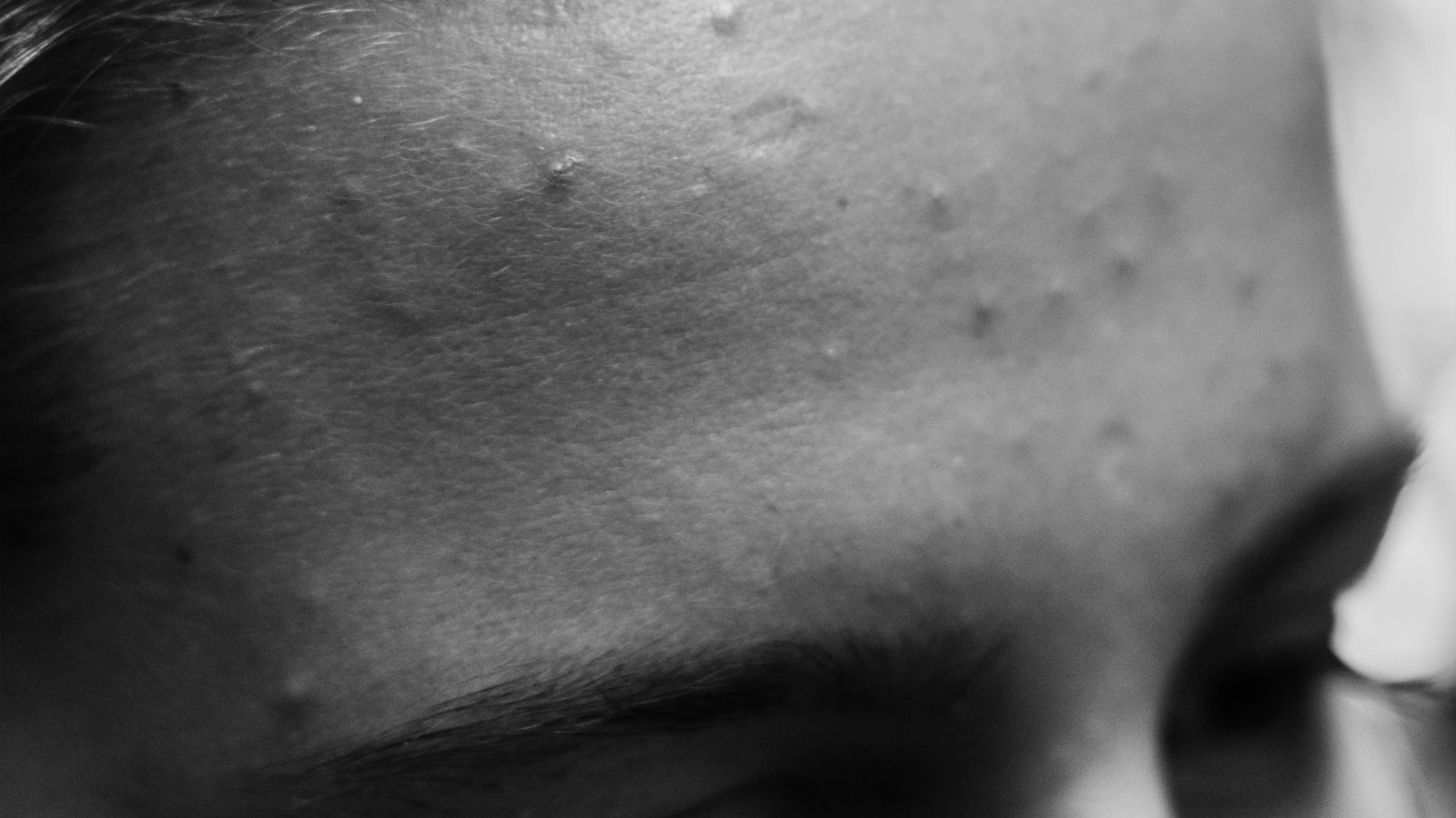 My ‘Breakout’ Debut 5 Closeup Black And White Image Of A Forehead With Textured Skin And Visible Pores.